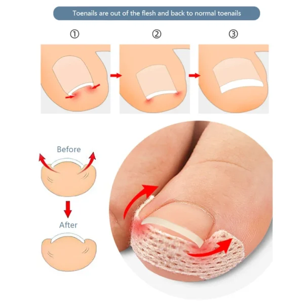 40/100pcs Orthodontic Nail Patch Ingrown Armor and Grow Into Flesh Toe Pad Corrector Pedicure Care Tool professional - Image 2